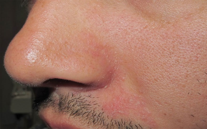 Dermatitis seborreica