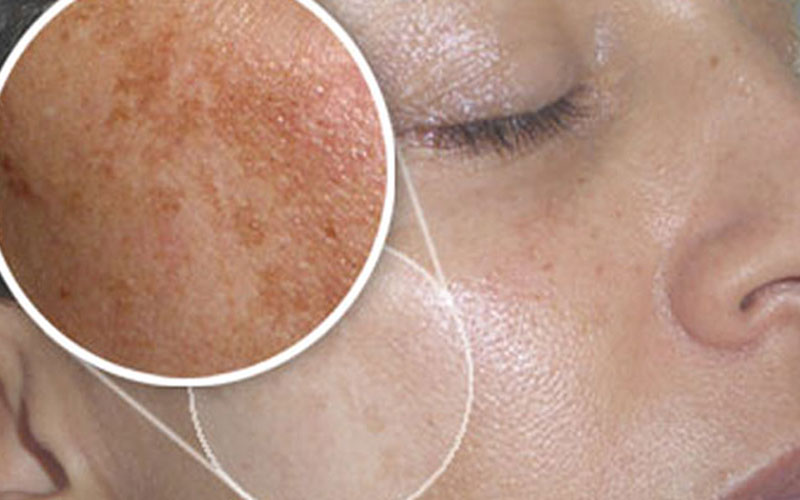 Melasma