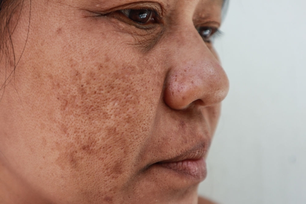 Melasma